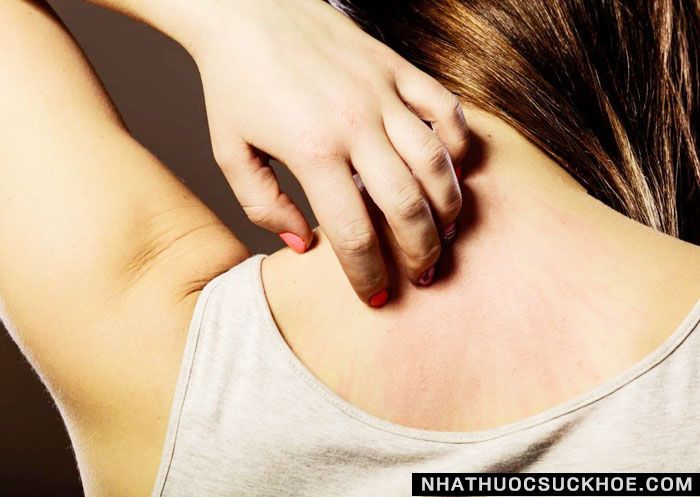Dị ứng hải sản nguy hiểm kh&ocirc;ng? K&eacute;o d&agrave;i bao l&acirc;u? C&oacute; tự khỏi kh&ocirc;ng? 1