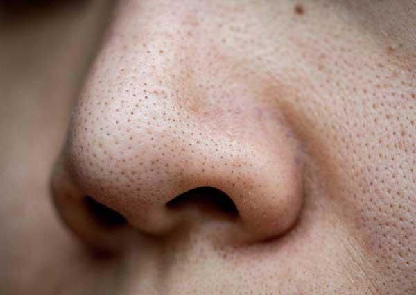 Mụn đầu đen l&agrave; xuất hiện những đốm li ti tr&ecirc;n mặt