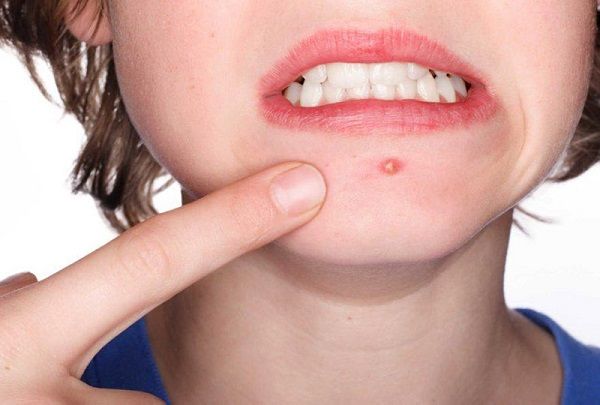 Mụn thường xuất hiện ở độ tuổi dậy th&igrave;