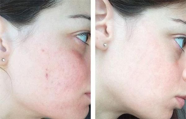 Niacinamide v&agrave; AHA/BHA