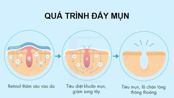 Retinol đẩy mụn trong bao l&acirc;u
