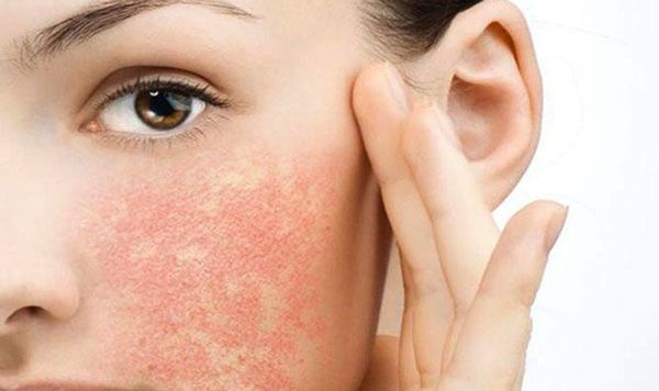 Dị ứng mỹ phẩm l&agrave; g&igrave;?