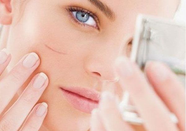 kem trị sẹo Hiruscar phục hồi t&aacute;i tạo da hư tổn