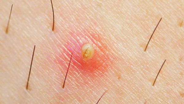 H&igrave;nh ảnh xưng mủ do l&ocirc;ng mọc ngược