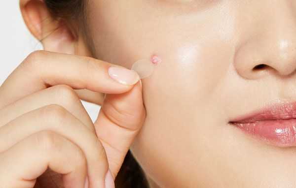 Miếng d&aacute;n mụn l&agrave; g&igrave;?