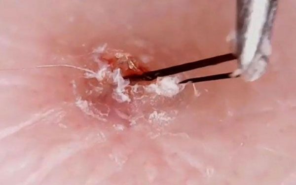 C&aacute;ch nhổ l&ocirc;ng mọc ngược