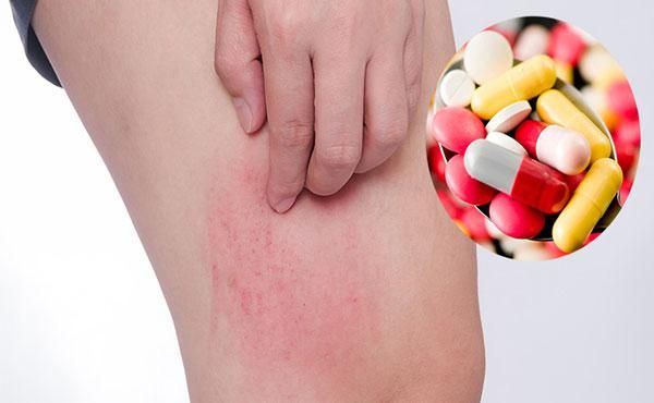 Điều trị dị ứng t&ocirc;m bằng thuốc&nbsp;