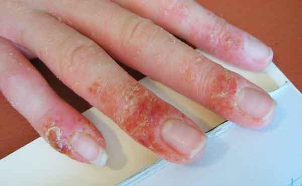 Bệnh &aacute; sừng