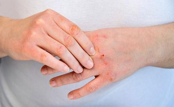 Bệnh vi&ecirc;m da cơ địa