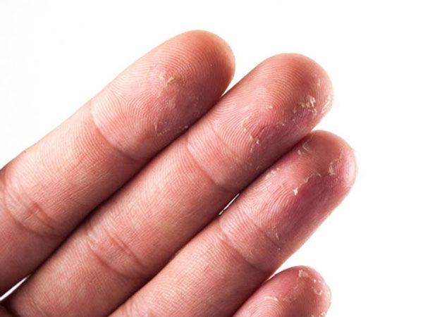Dư thừa hoặc thiếu hụt vitamin&nbsp;