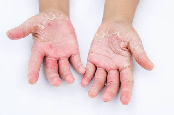 Da tay bị bong tr&oacute;c l&agrave; bệnh g&igrave;? Nguy&ecirc;n nh&acirc;n v&agrave; c&aacute;ch phục hồi da?