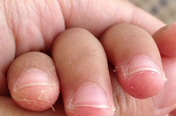Bệnh vi&ecirc;m da tiếp x&uacute;c