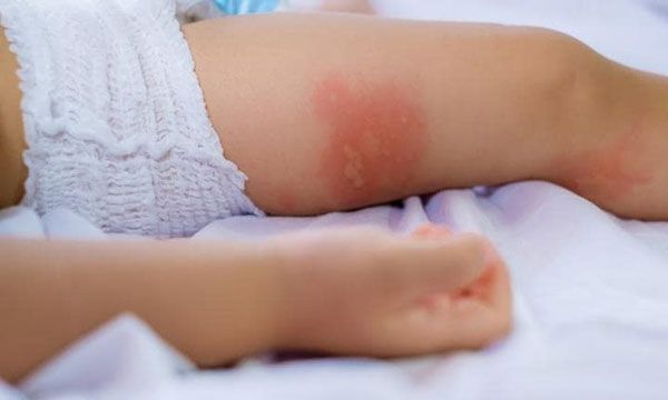 D&ugrave;ng m&aacute;y đuổi muỗi ngăn ngừa bệnh sốt xuất huyết