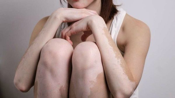 Bệnh bạch biến to&agrave;n th&acirc;n thường bị cả 2 b&ecirc;n cơ thể