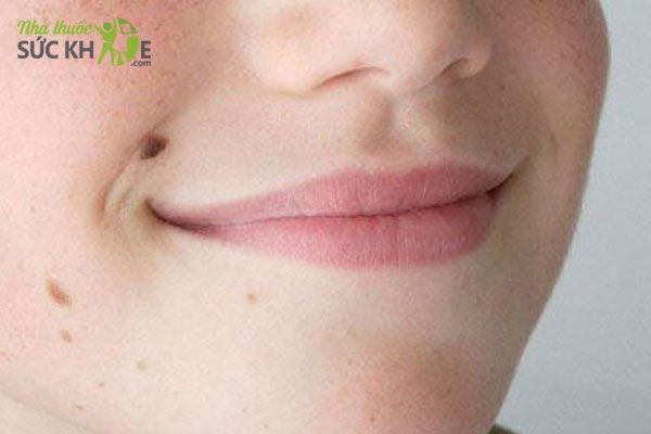 ưu điểm v&agrave; nhược điểm của phương ph&aacute;p tẩy nốt ruồi bằng tỏi
