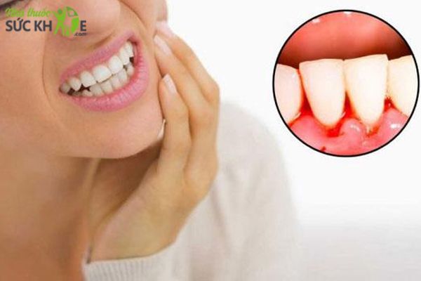 Thuốc Rutin C hiệu quả trong việc ngăn ngừa chảy m&aacute;u ch&acirc;n răng