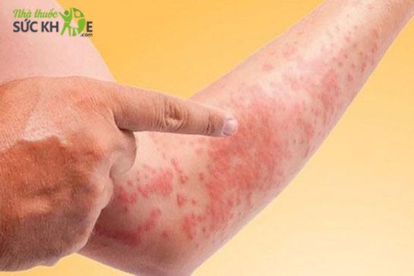 Điều trị bệnh da liễu