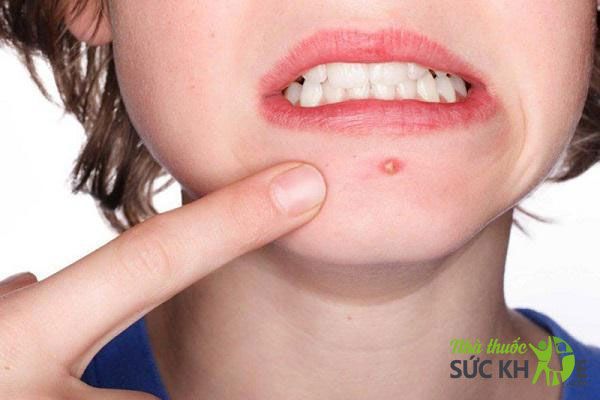 Chọn sản phẩm đặc trị theo t&igrave;nh trạng mụn&nbsp;