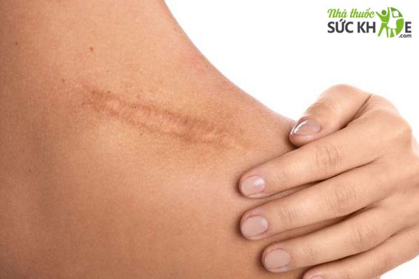 K&iacute;ch th&iacute;ch vết thương mau liền sẹo