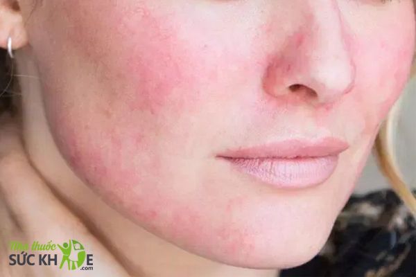 C&aacute;ch chăm s&oacute;c da nhạy cảm v&agrave; da mụn v&agrave;o m&ugrave;a đ&ocirc;ng