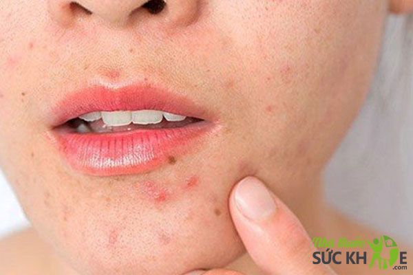 Uống collagen c&oacute; bị nổi mụn kh&ocirc;ng
