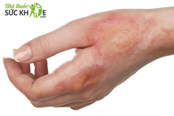 C&aacute;ch l&agrave;m giảm đau r&aacute;t khi bị bỏng như thế n&agrave;o?