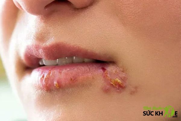 C&aacute;c bệnh về da liễu- Chốc lở