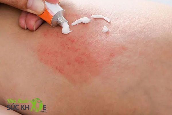 Khi n&agrave;o n&ecirc;n d&ugrave;ng kem trị vi&ecirc;m nang l&ocirc;ng