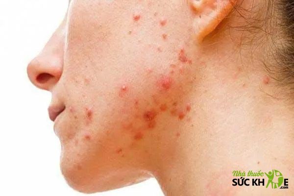 H&igrave;nh ảnh c&aacute;c bệnh về da mặt- Mụn trứng c&aacute;