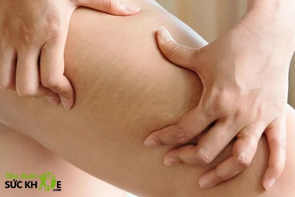 Rạn da l&agrave; t&igrave;nh trạng xuất hiện c&aacute;c vết l&otilde;m c&oacute; m&agrave;u r&otilde; tr&ecirc;n da