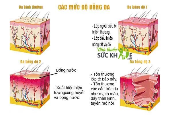 T&igrave;m hiểu c&aacute;c mức độ bỏng để c&oacute; c&aacute;ch xử l&yacute; ph&ugrave; hợp