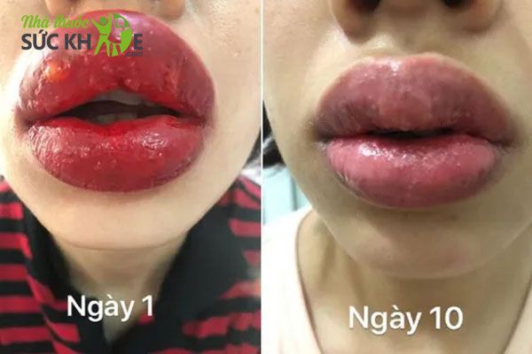 Phun m&ocirc;i bị sưng l&acirc;u
