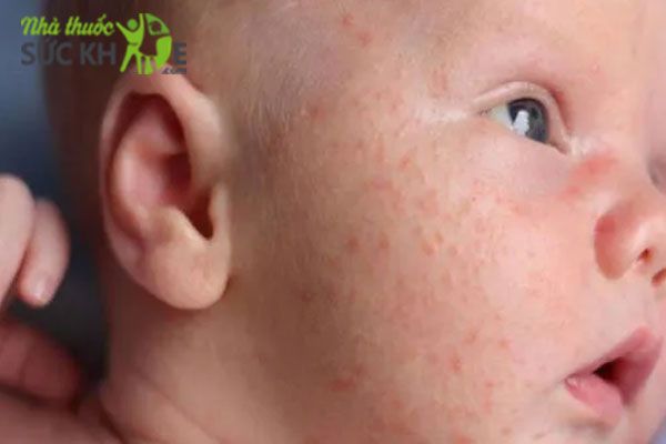 Nhiều ba mẹ chưa ch&uacute; &yacute; đến vấn đề vệ sinh khi chăm s&oacute;c l&agrave;n da bị ch&agrave;m cho b&eacute;&nbsp;