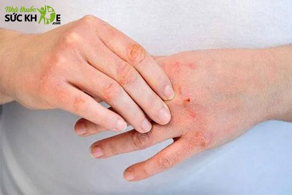 Vi&ecirc;m da cơ địa bề mặt da nổi nhiều mụn nước