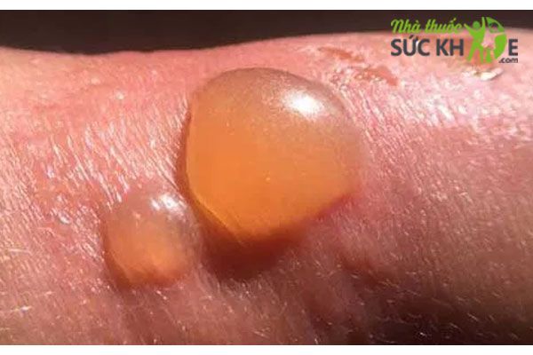 Tr&aacute;nh chạm v&agrave;o vết phồng rộp