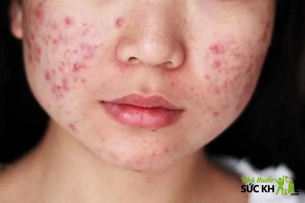 C&aacute;c bệnh về da mặt- Vi&ecirc;m da tiết b&atilde;