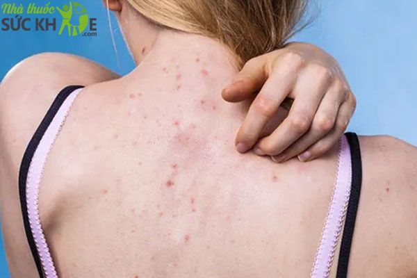 Vi&ecirc;m nang l&ocirc;ng biểu hiện như thế n&agrave;o
