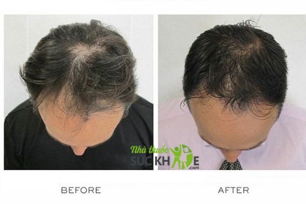 Thuốc mọc t&oacute;c của Nhật l&agrave; g&igrave;