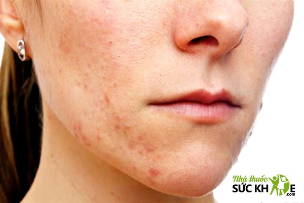Dị ứng sữa rửa mặt