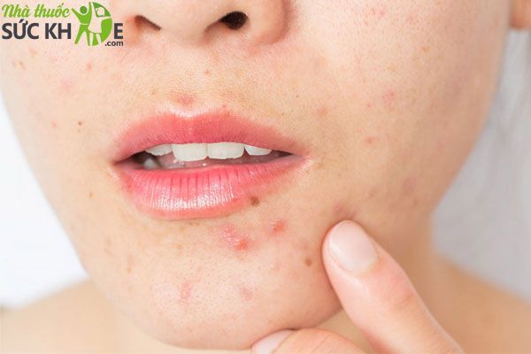 Review kem dưỡng ẩm Clinique cho da dầu mụn
