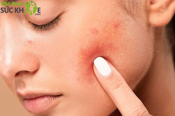 Tại sao n&ecirc;n d&ugrave;ng kem dưỡng ẩm La Roche Posay