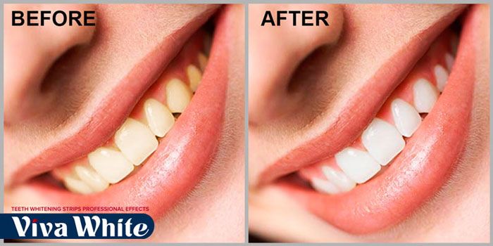 Giúp hàm răng trắng sáng 6-8 độ màu chỉ sau một liều trình điều trị đầy đủ