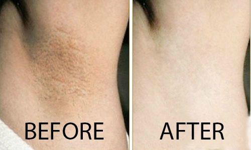 Tinh chất trị thâm nách giúp loại bỏ các tế bào da chết, làm sạch bụi bẩn ẩn sâu trong các lỗ chân lông