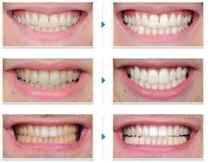 Gel tẩy trắng răng 7 ngày DR.Haiian giúp tẩy sạch các mảng bám lâu ngày trên răng, trả lại vẻ sang bóng cho hàm răng