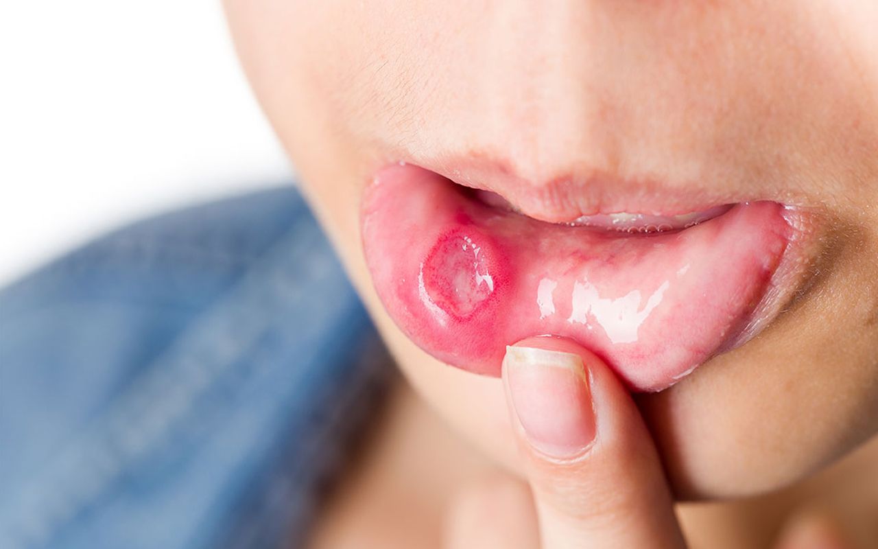 Oracortia hỗ trợ cải thiện tình trạng viêm loét miệng hiệu quả.