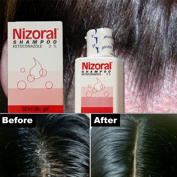 Công dụng dầu gội trị nấm da đầu Nizoral