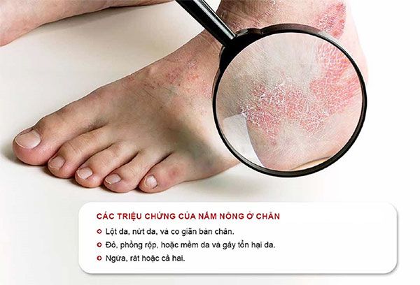 Triệu chứng bệnh nấm da chân