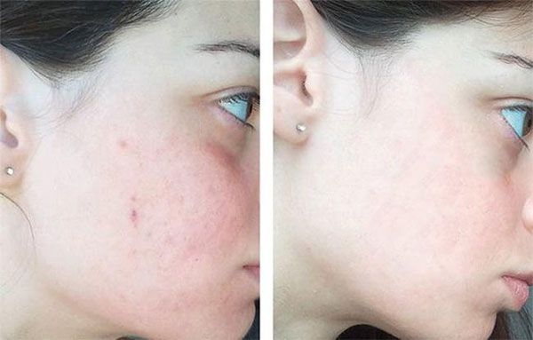 Cách sử dụng Serum The Ordinary Niacinamide 10% Zinc 1% HIỆU QUẢ