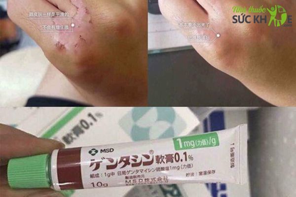 Kem hỗ trợ cải thiện sẹo Gentacin đáp ứng tốt với da