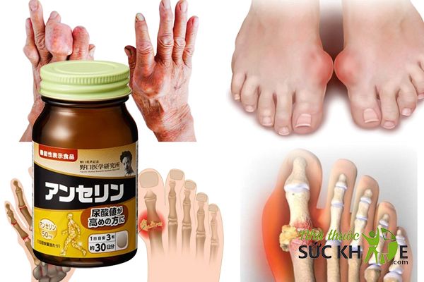 Phòng ngừa các biến chứng do gout